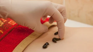 Pijawki zaleca się przy żylakach i obrzękach nóg