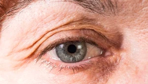 Półpasiec oczny powoduje ból, swędzenie i pieczenie oka. Na powiece pojawia się również wysypka z pęcherzami