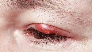 Gradówka to mały guzek na powiece