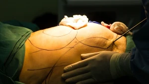 Dzięki liposukcji osoby otyłe mogą się poczuć lepiej we własnym ciele