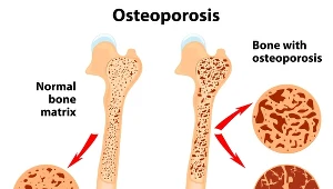 Na osteoporozę cierpią przede wszystkim osoby starsze
