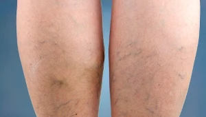 Żylaki to nie tylko problem estetyczny