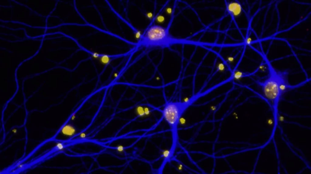 Płytki amyloidowe w mózgu redukują poziom BRCA1 (czerwone) w neuronach (niebieskie)