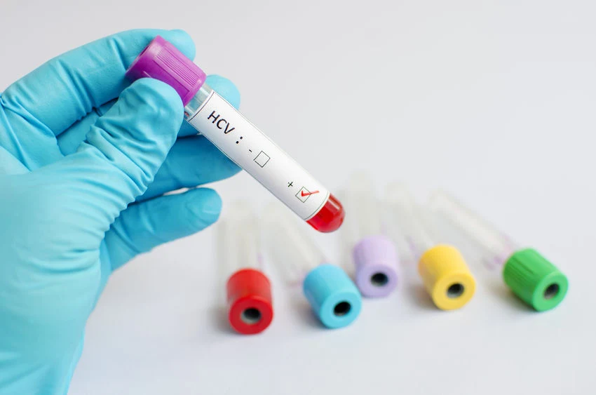 WZW typu C powiązane z chorobą Parkinsona - nie wiadomo skąd ta zależność WZW typu C powiązane z chorobą Parkinsona - nie wiadomo skąd ta zależność