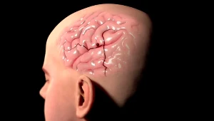 Tętniak to okresowe poszerzenie ścian tętnicy, które stopniowo wypełnia się krwią i skrzepliną