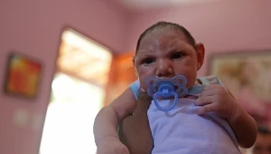 Najwięcej przypadków mikrocefalii (małogłowia) zanotowano w Ameryce Południowej 