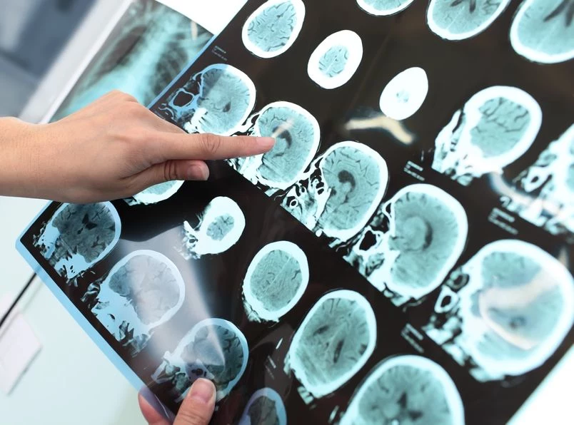 Naukowcy są coraz bliżej pokonania choroby Alzheimera?