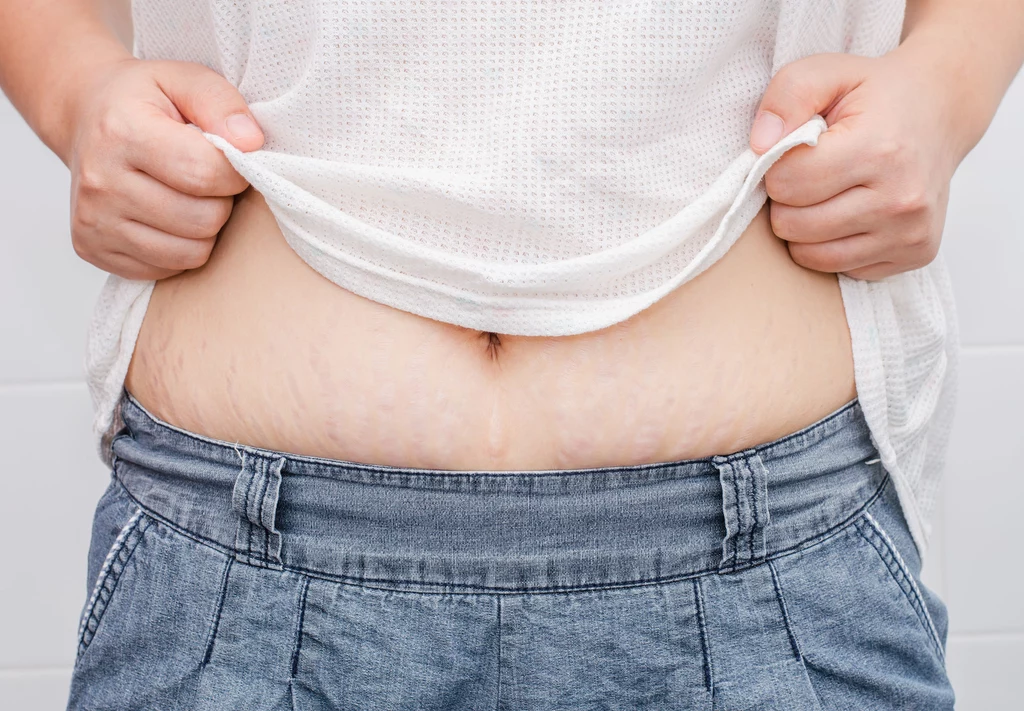 Na pojawienie się rozstępów, podobnie jak w przypadku cellulitu, narażona jest większość kobiet Na pojawienie się rozstępów, podobnie jak w przypadku cellulitu, narażona jest większość kobiet
