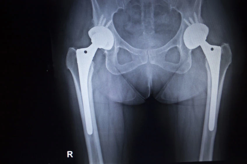 Supertwardy stop będzie można wykorzystać np. w implantach biomedycznych