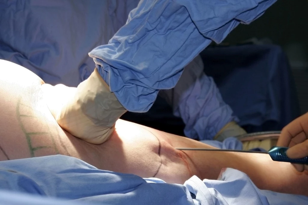 Lipoaspiracja zwana jest też liposukcją Lipoaspiracja zwana jest też liposukcją