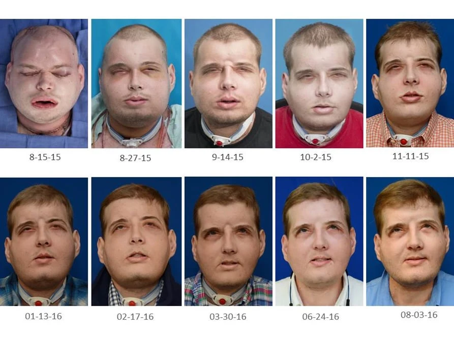 Rehabilitacja od przeszczepu do dzisiaj