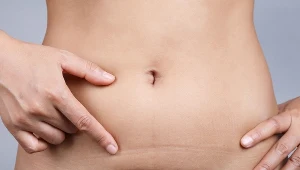 Rekonwalescencja po przebytej histerektomii trwa około 8 tygodni