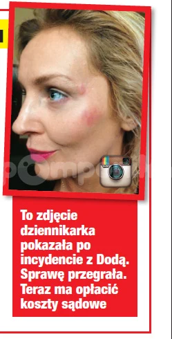 Szulim pokazała to zdjęcie jako dowód pobicia przed Dodę Szulim pokazała to zdjęcie jako dowód pobicia przed Dodę