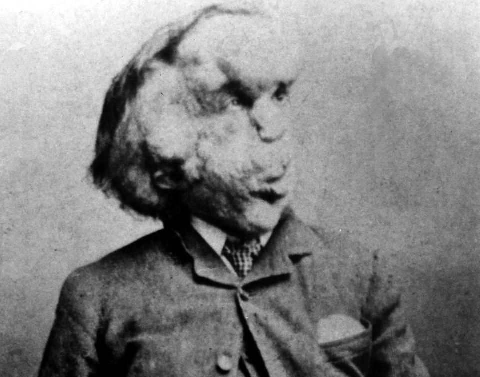 Brytyjczyk Joseph Merrick