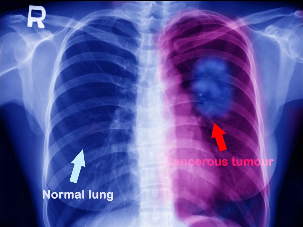 Porównanie płuca zdrowego z płucem zaatakowanym przez nowotwór