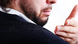 Łupież może być oznaką poważniejszych schorzeń