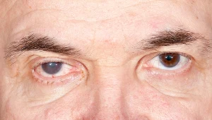 Zaćma doskwiera najczęściej osobom starszym