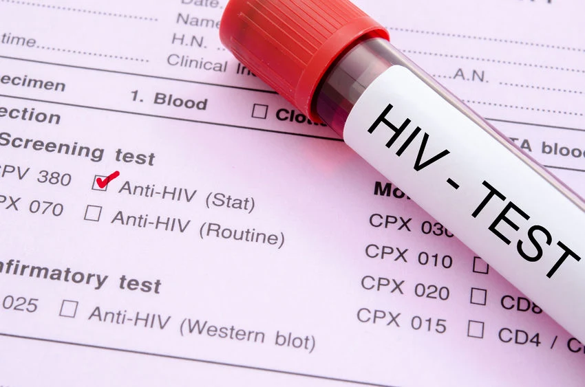 Wirus HIV groźniejszy niż SARS-CoV-2 Wirus HIV groźniejszy niż SARS-CoV-2