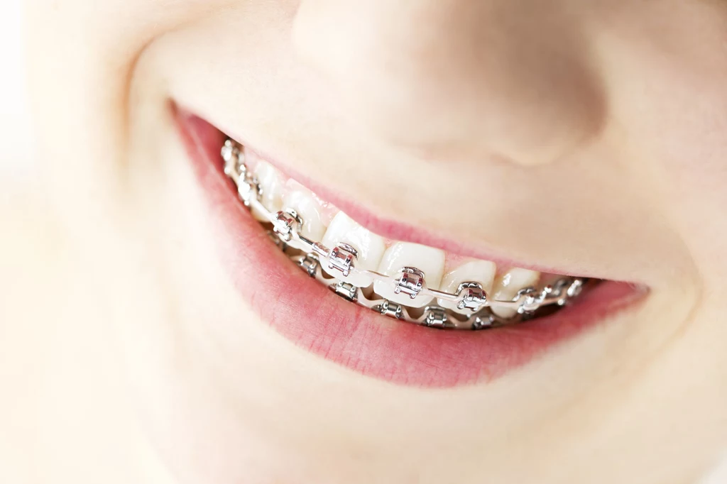 Tradycyjne aparaty ortodontyczne z metalowymi zamkami to nie jedyna metoda na idealnie proste zęby