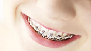Aparaty ortodontyczne dla dorosłych – jak wybrać właściwy?