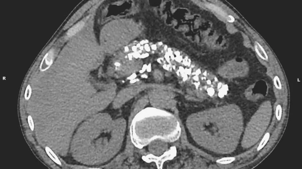 Na zdjęciu z CT widać zwapniałą trzustkę