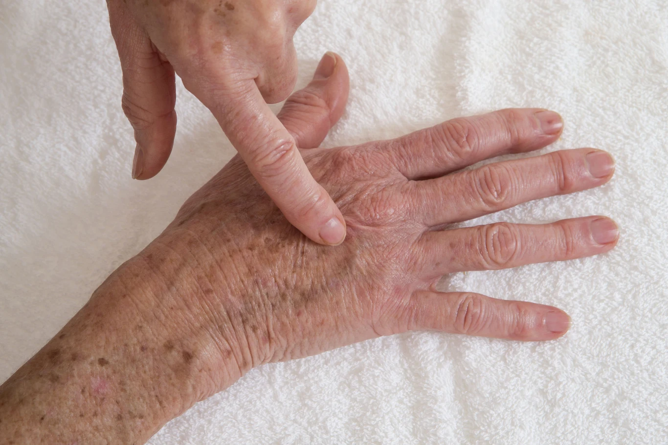 Plamek i przebarwień na dłoniach możesz się łatwo pozbyć, stosując odpowiednie kremy. Warto także wypróbować domowe sposoby, aby zmniejszyć ich widoczność Plamek i przebarwień na dłoniach możesz się łatwo pozbyć, stosując odpowiednie kremy. Warto także wypróbować domowe sposoby, aby zmniejszyć ich widoczność