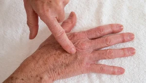 Masz plamy starcze na dłoniach? Usuniesz je bez lasera i drogich kosmetyków