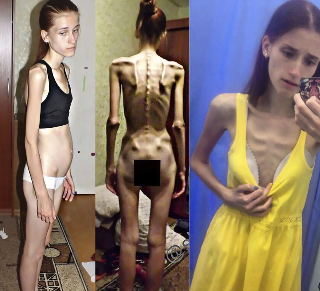 Vera Schulz w 2014 roku ważyła 33 kg