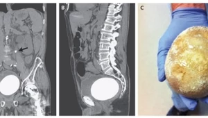 64-latkowi usunięto gigantyczny kamień z pęcherza moczowego