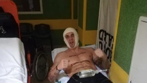 Adam Balski złamał szczękę w ringu