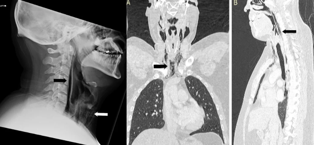 Badania pokazały, że pacjent nabawił się poważnego urazu / fot: BMJ Case Reports