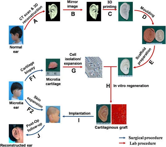 Schemat procedury /fot. EBioMedicine