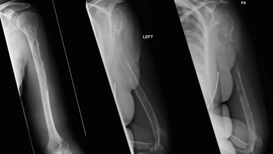 Radiograf 44-letniej pacjentki pokazuje relokacje niszczonej kości ramiennej, która nastąpiła w ciągu 18 miesięcy Radiograf 44-letniej pacjentki pokazuje relokacje niszczonej kości ramiennej, która nastąpiła w ciągu 18 miesięcy
