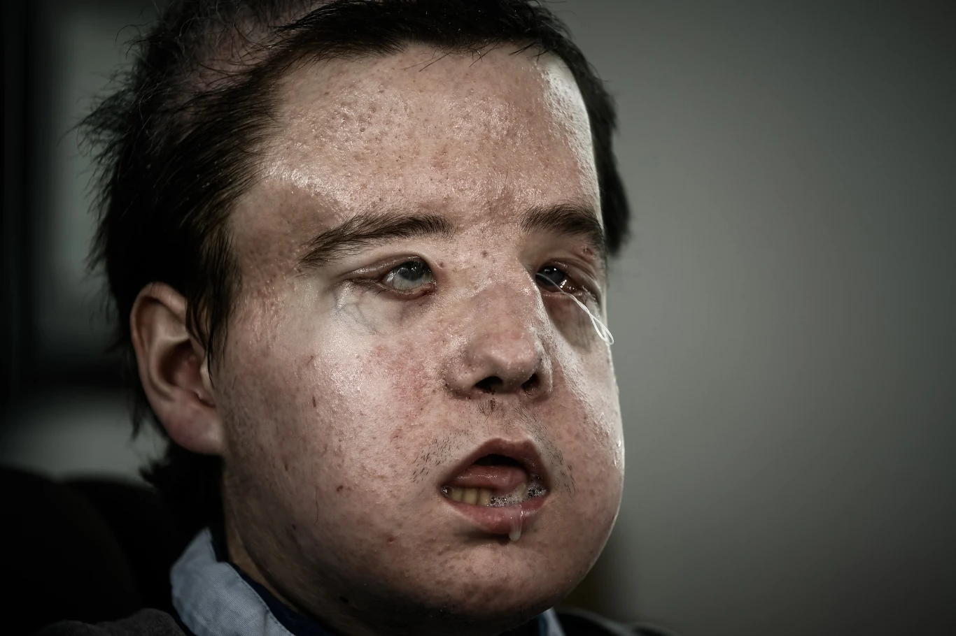 Jerome Hamon to pierwszy człowiek na świecie, który przeszedł drugi przeszczep twarzy Jerome Hamon to pierwszy człowiek na świecie, który przeszedł drugi przeszczep twarzy