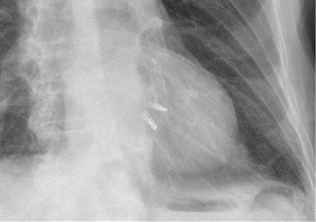 Zdjęcie RTG przedstawiające dwa urządzenia MitraClips umieszczone w sercu /Fot. Hellerhoff