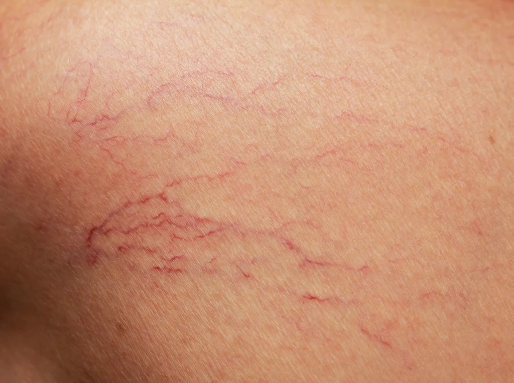 Zmiany skórne nazywane potocznie pajączkami to sieci rozszerzonych drobnych żyłek widoczne pod skórą Zmiany skórne nazywane potocznie pajączkami to sieci rozszerzonych drobnych żyłek widoczne pod skórą