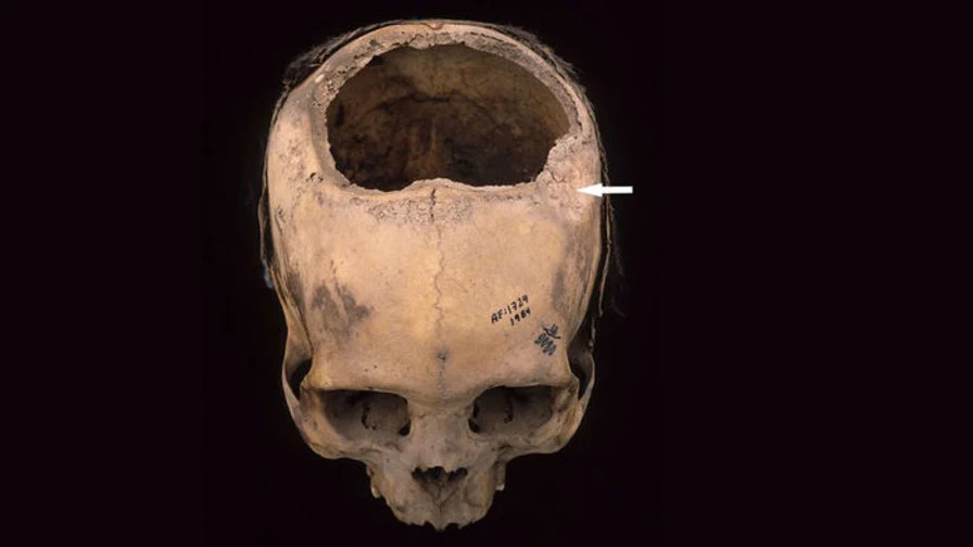 Inkowie byli lepsi w trepanacji czaszki niż lekarze podczas wojny secesyjnej Inkowie byli lepsi w trepanacji czaszki niż lekarze podczas wojny secesyjnej