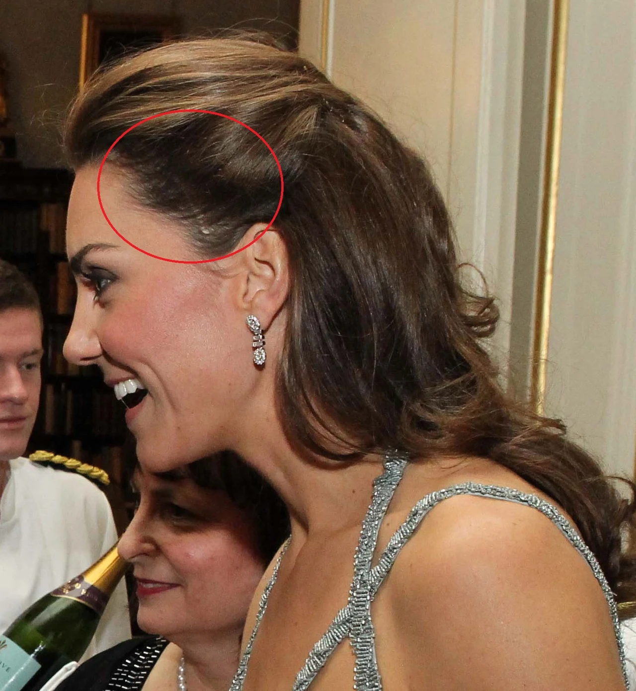 Blizna księżnej Kate Blizna księżnej Kate