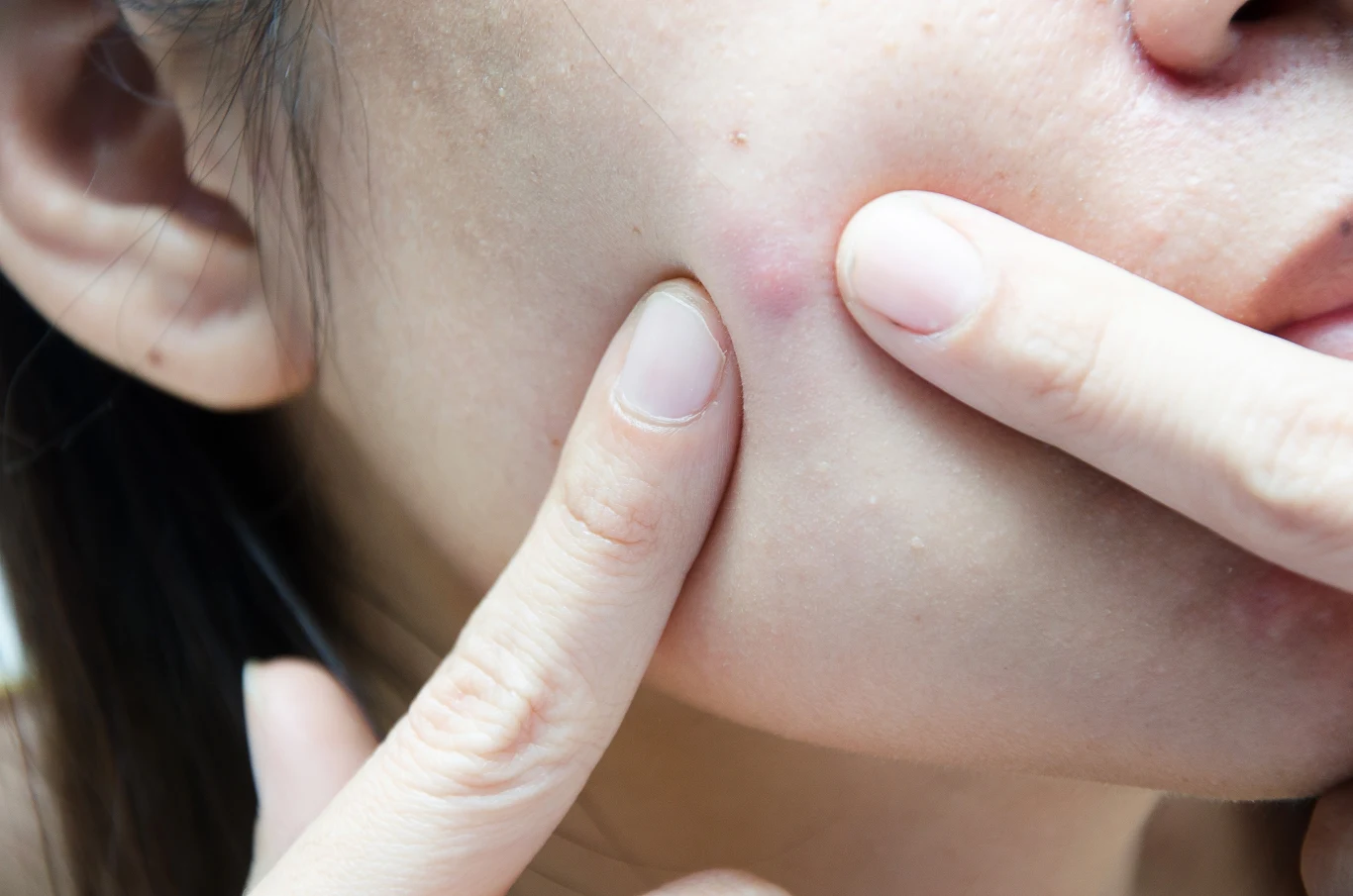 Trądzik często bywa oznaką nietolerancji pokarmowych