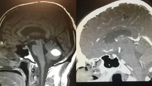 Cudowne zniknięcie guza mózgu czy błąd lekarzy?