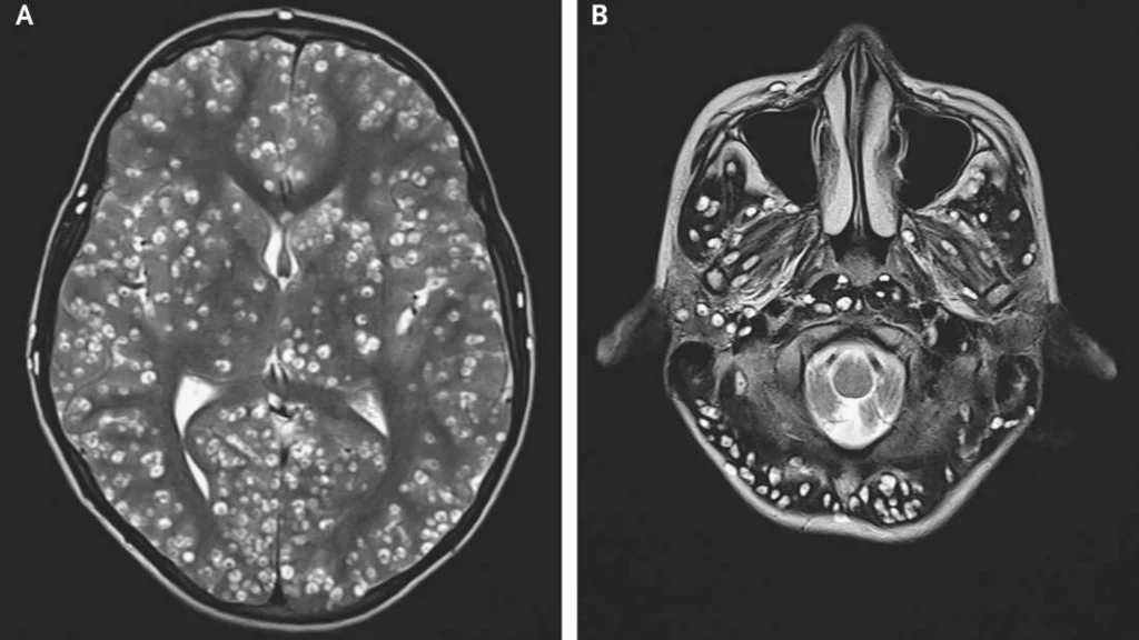 Zdjęcia skanów mózgu pacjenta zarażonego tasiemcem /Fot. The New England Journal of Medicine