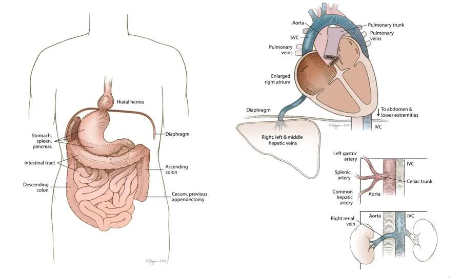 Ilustracja po lewej obrazuje situs inversus z lewokaridą u Rosie Marie Bentley, pozostałe schematy prezentują inne wady anatomiczne u zmarłej kobiety /Fot. Uniwersytet Oregonu