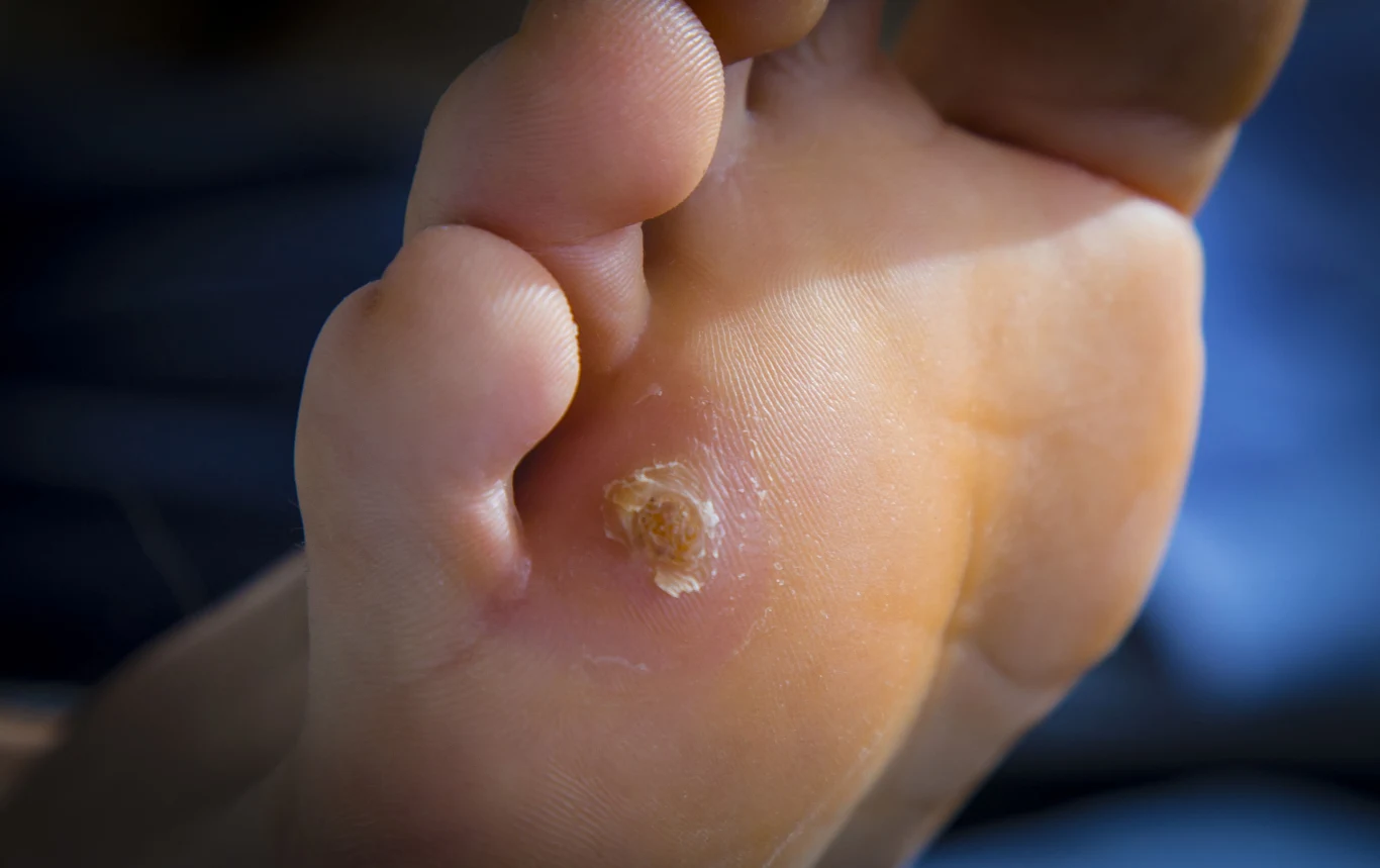 Przyłóż miąższ pomidora bezpośrednio na zmiany. Powtarzaj 6-8 dni.
Przyłóż miąższ pomidora bezpośrednio na zmiany. Powtarzaj 6-8 dni.