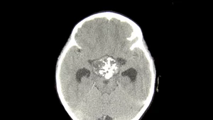 Niezwykle rzadki przypadek - zęby w mózgu