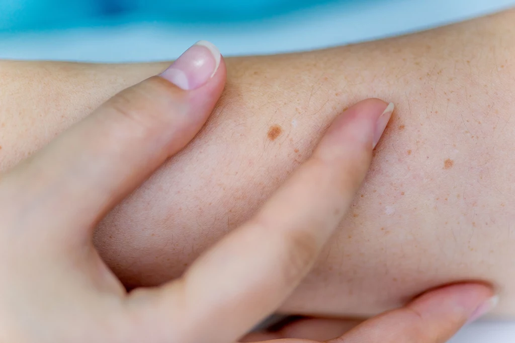 Jeśli zauważysz, że coś podejrzanego dzieje się ze znamieniem, idź do dermatologa lub chirurga onkologa