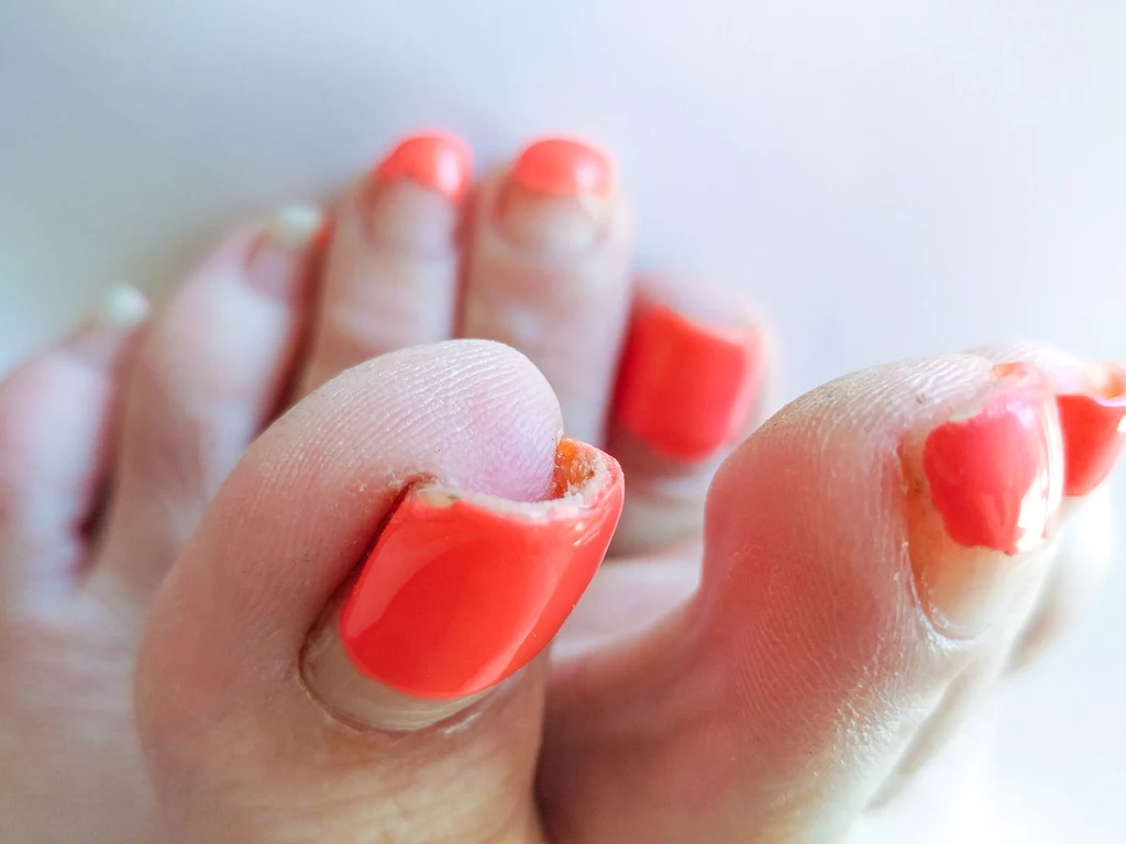 Właściwa pielęgnacja stóp i paznokci minimalizuje ryzyko schorzeń