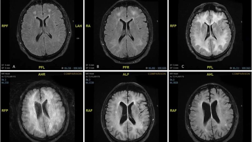 Skany MRI pacjenta pokazują stopniową degenerację substancji białej w mózgu