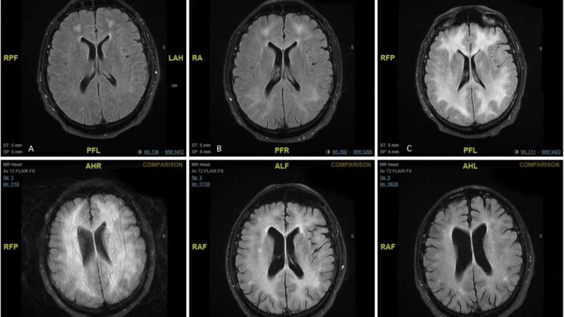 Skany MRI pacjenta pokazują stopniową degenerację substancji białej w mózgu Skany MRI pacjenta pokazują stopniową degenerację substancji białej w mózgu