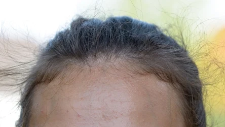 Jak uniknąć zmarszczek na czole?