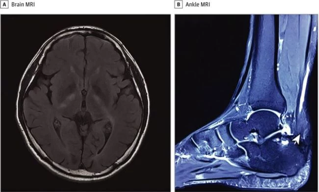 Na zdjęciu MRI mózgu pacjenta (A) i kostki (B). Strzałka na zdjęciu B wskazuje powiększenie ścięgna Achillesa pacjenta, które zwęża się na końcu /Fot. JAMA Neurology